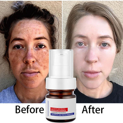 🔥FLASH SALE：⚡5-second brightening rescue: Dark spots disappear, blemishes fade, and skin becomes radiant! Vitamin C Whitening Freckles ESSENCE