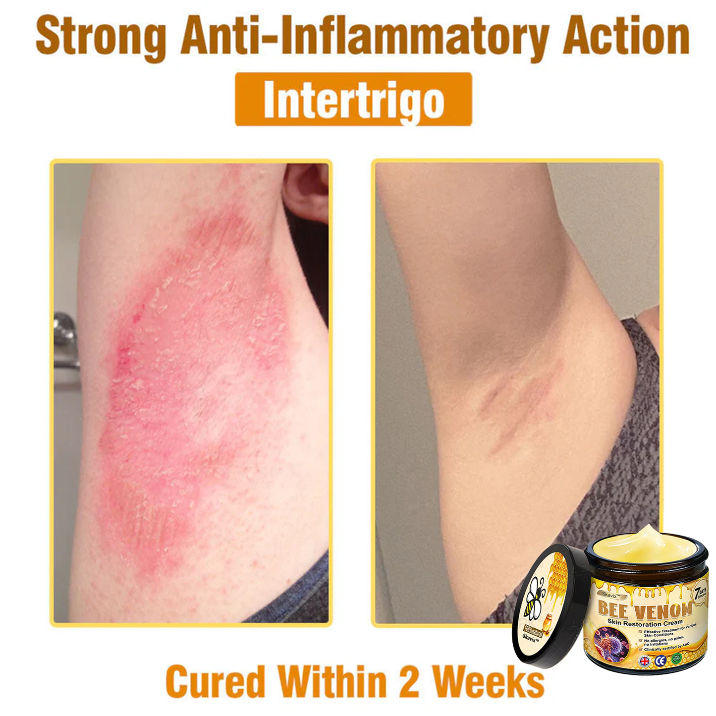 ✨✨Skavix™ Bee venom Comprehensive Cream — 🔥Limited Time 80% OFF🔥