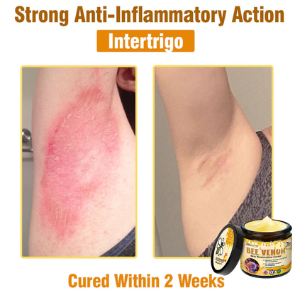 ✨✨Skavix™ Bee venom Comprehensive Cream — 🔥Limited Time 80% OFF🔥